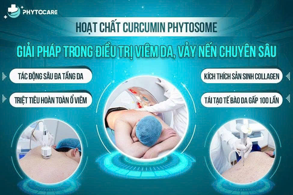 Đột Phá Trong Điều Trị Viêm Da, Vảy Nến: Hoạt chất Curcumin Phytosome Có Gì Đặc Biệt?